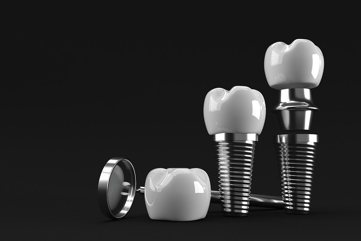 Render 3D impianto dentale