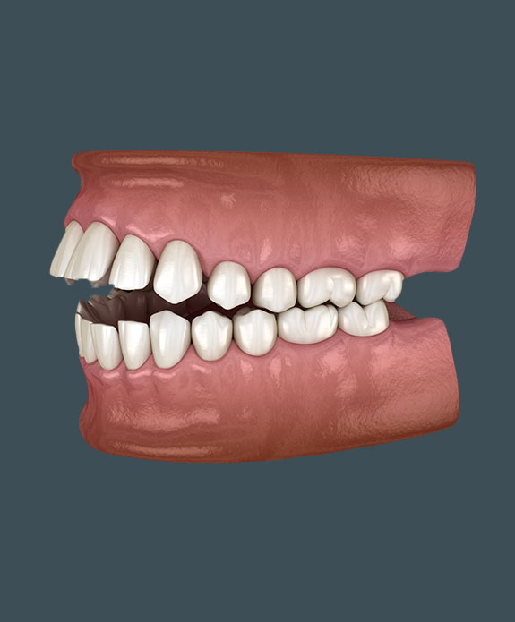 Render 3D malocclusione